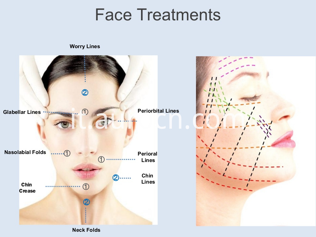 DOP-presentazione Cog 3D Pdo Thread Lift Korea